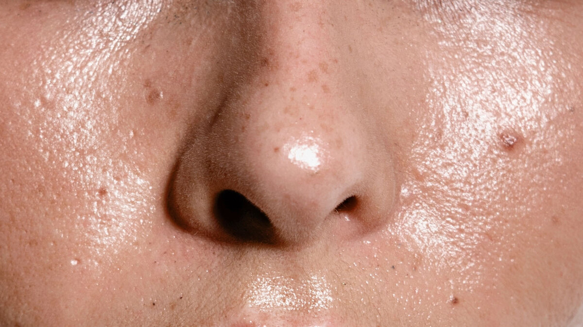  جزء من الوجه تظهر فيه البشرة الدهنية وهي تعاني من الحبوب وبعض المشاكل الأخرى 