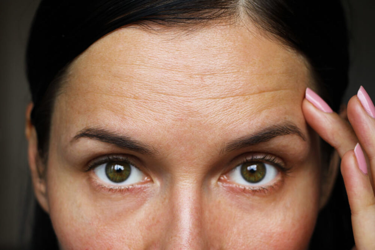 وجه فتاة تعاني من بعض التجاعيد في منطقة الجبين وهي تشير اليها باصبعها