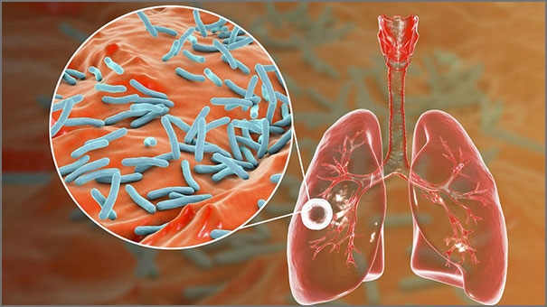 Bacterial infections caused by tuberculosis