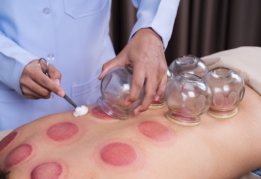 Cupping