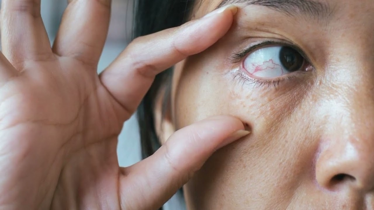 انسداد جزئي في الوريد الشبكي انسداد جزئي في الوريد الشبكي