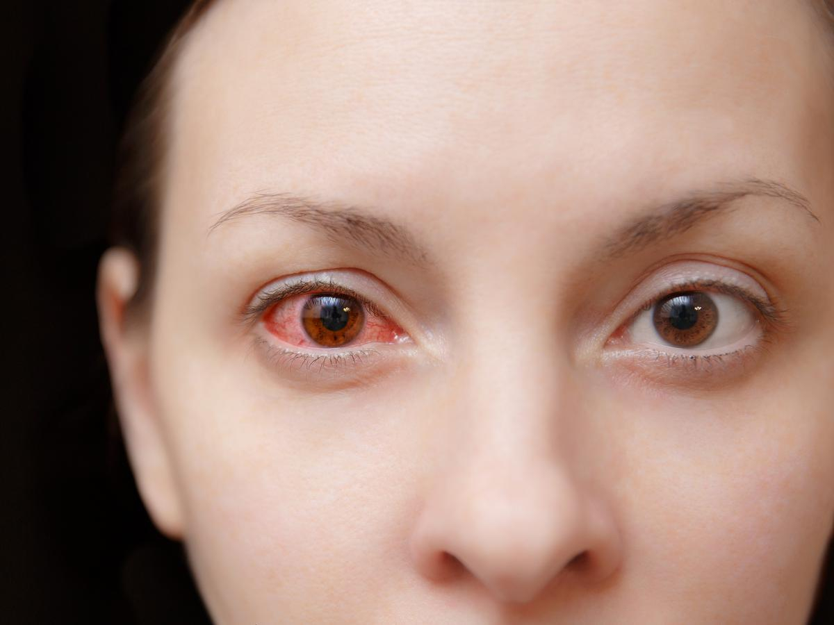 انسداد كلي في الوريد الرئيس للشبكية انسداد كلي في الوريد الرئيس للشبكية