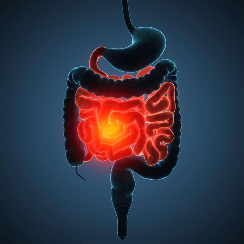 Ulcerative colitis Ulcerative colitis