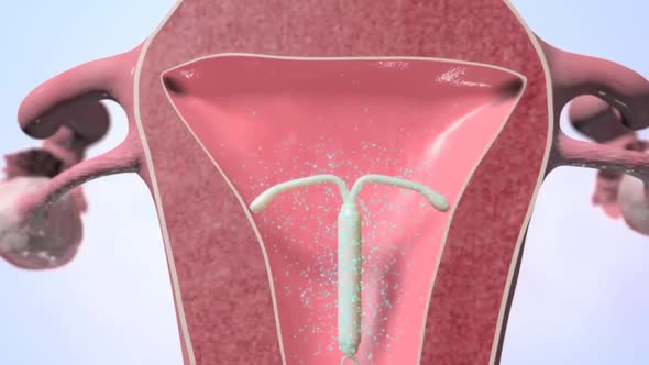 رسم لرحم المرأة وتظهر في داخلة اللولب النحاسي لمنع الحمل واعاقة مرور النطاف 