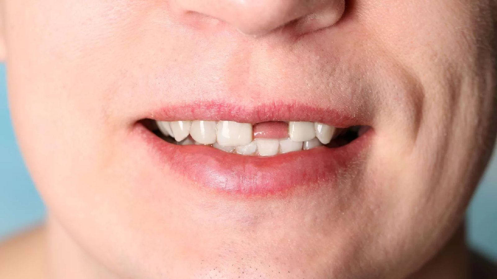 تساقط الأسنان