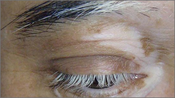 vitiligo