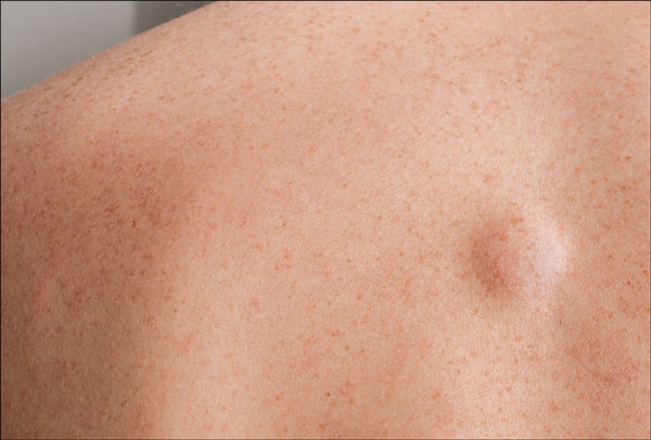 متى تحتاج إلى طلب العلاج الطبي بشأن الأورام الشحمية