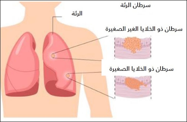 أنواع سرطان الرئة