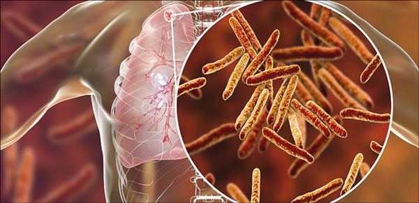 إحصائيات عن مرض السل