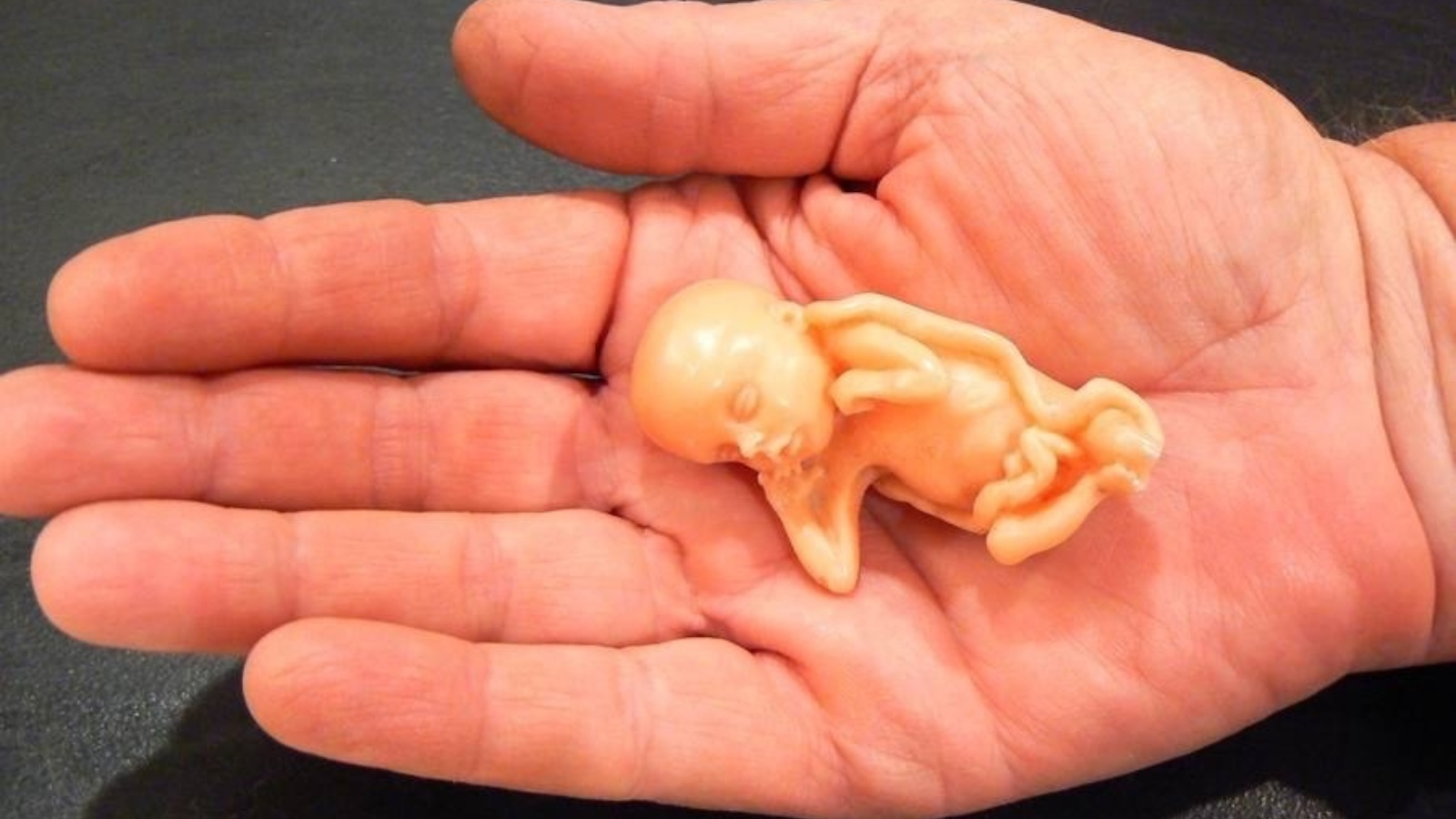 الإجهاض المتكرر