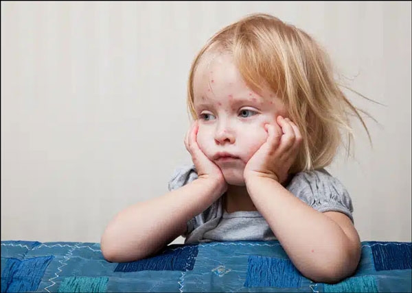 الالتهابات الفطرية