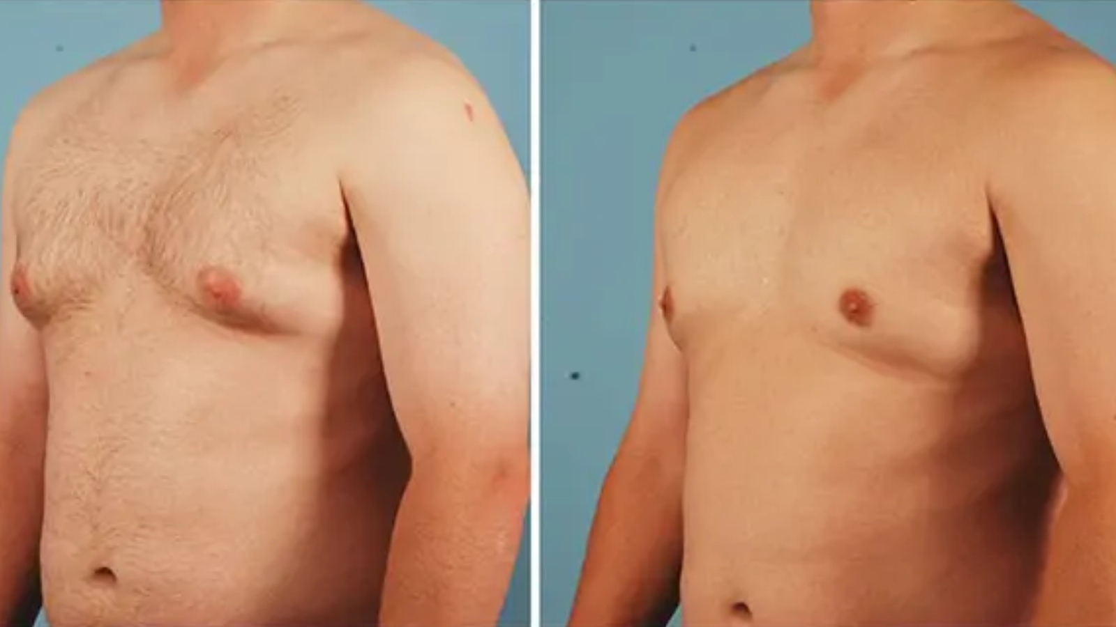 التثدي عند الرجل