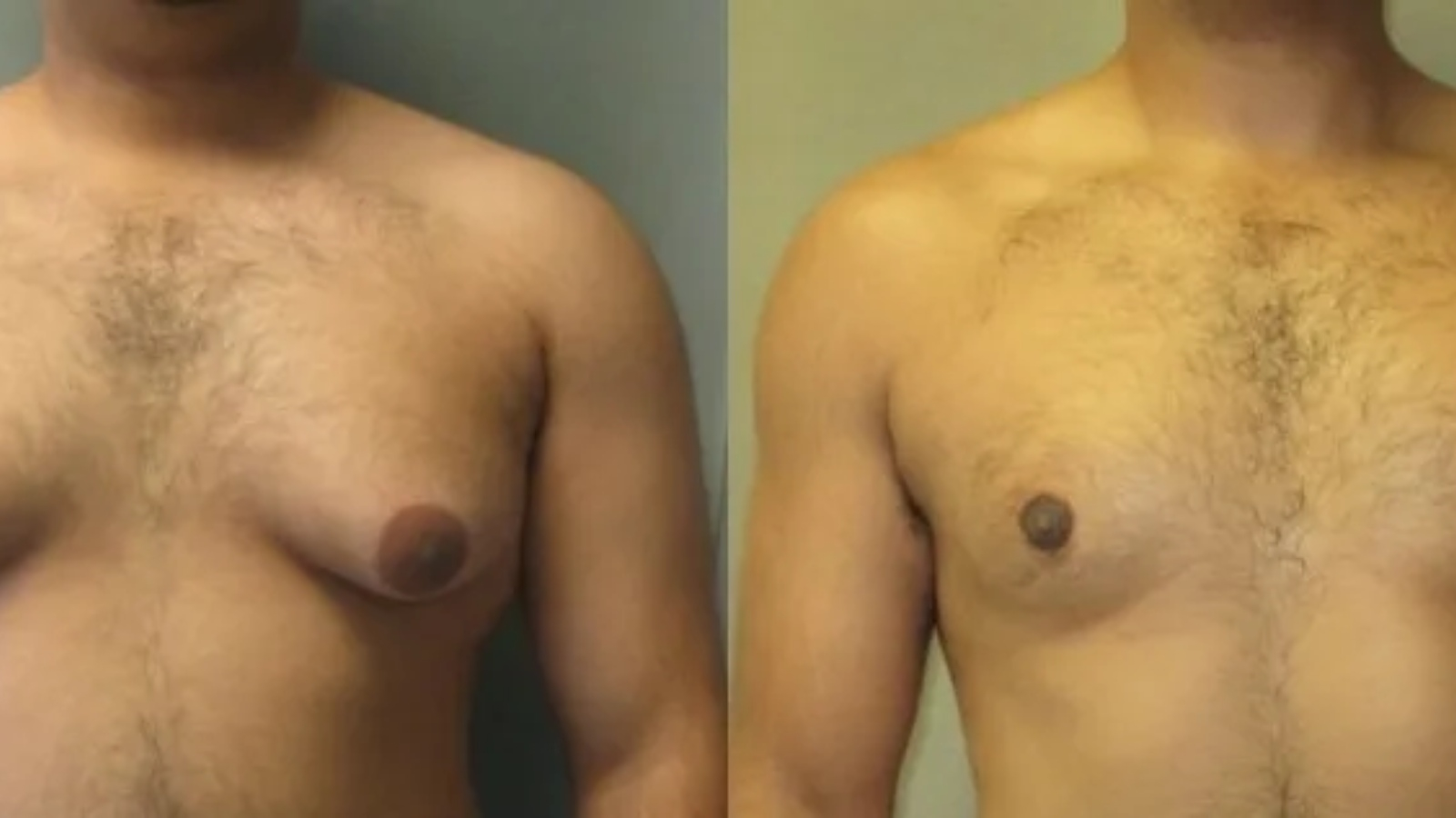 التثدي عند الرجل