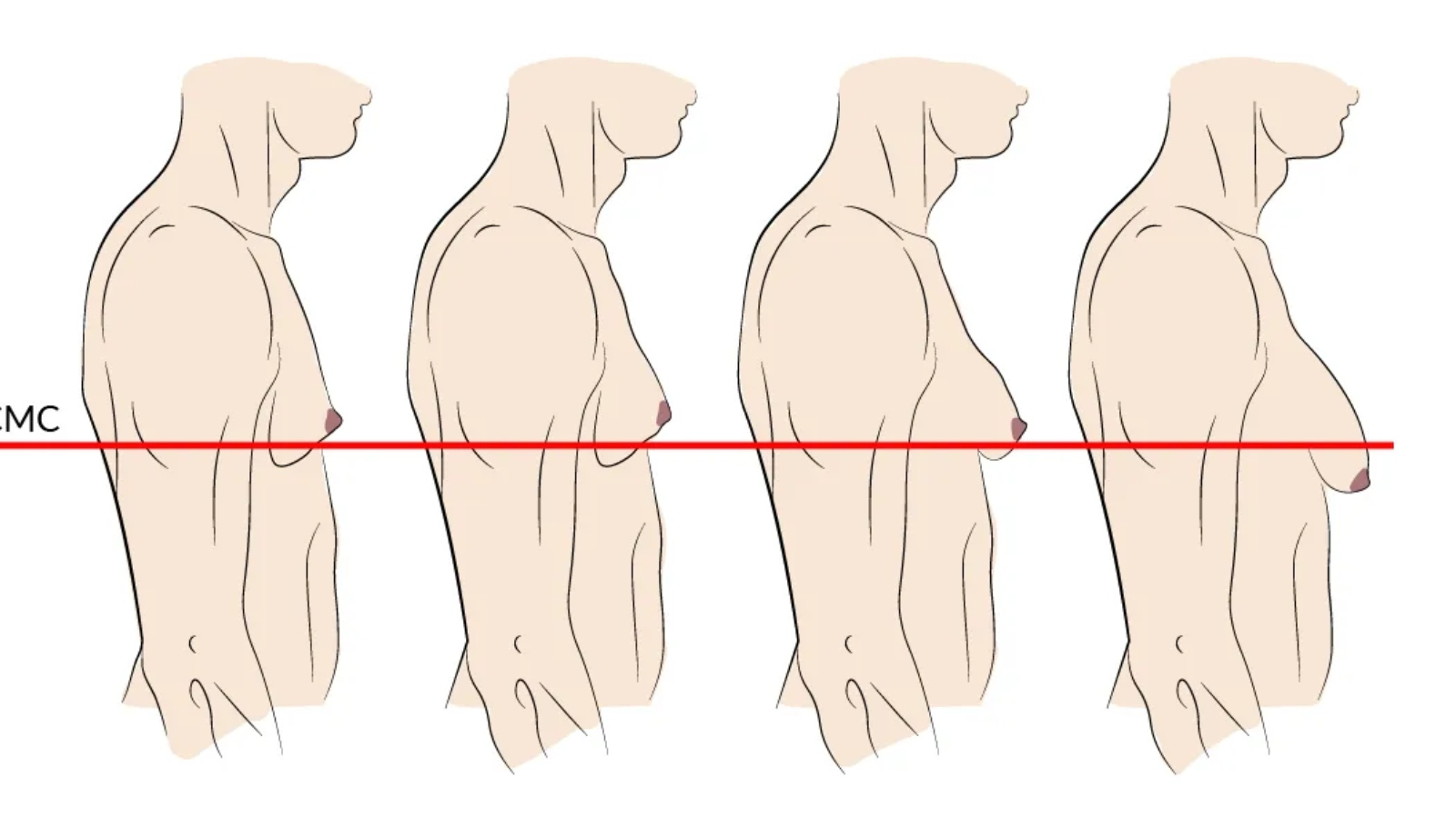 التثدي عند الرجل