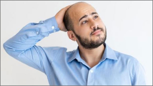 الصلع الوراثي