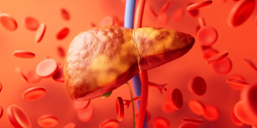 الكبد الدهني