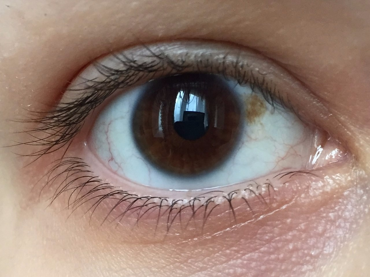 انسداد جزئي في الشريان الشبكي انسداد جزئي في الشريان الشبكي