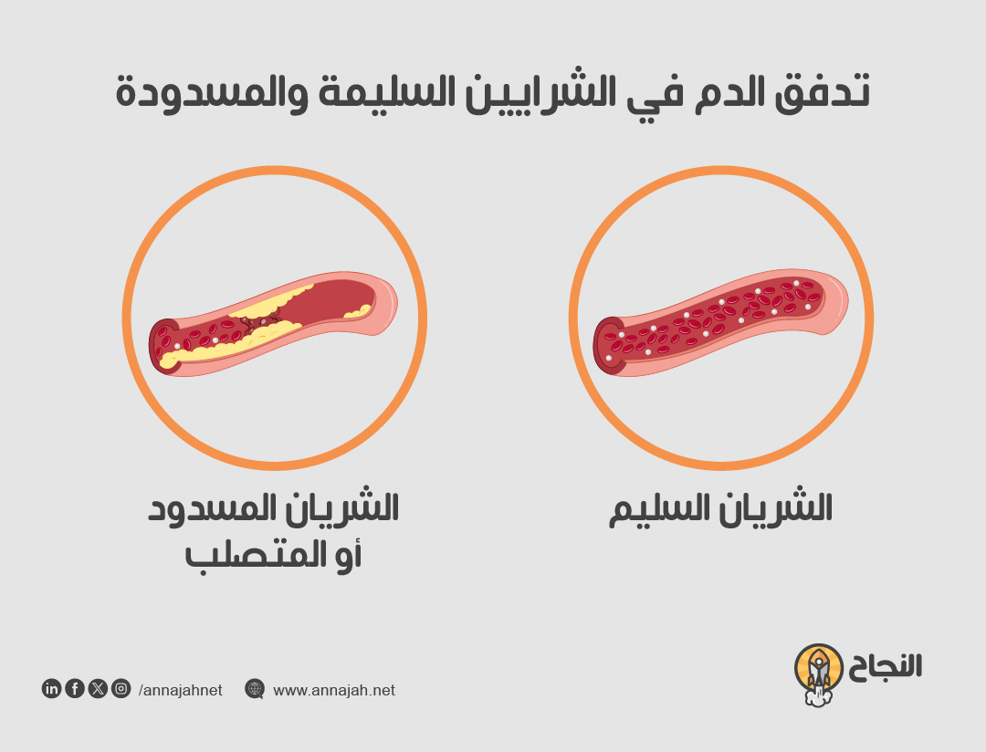 صورة توضيحية لتدفق الدم في الشرايين السليمة والمسدودة