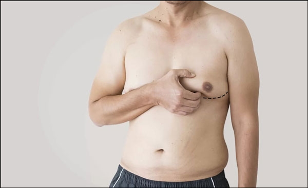 طرائق التخلُّص من التثدِّي عند الرجال