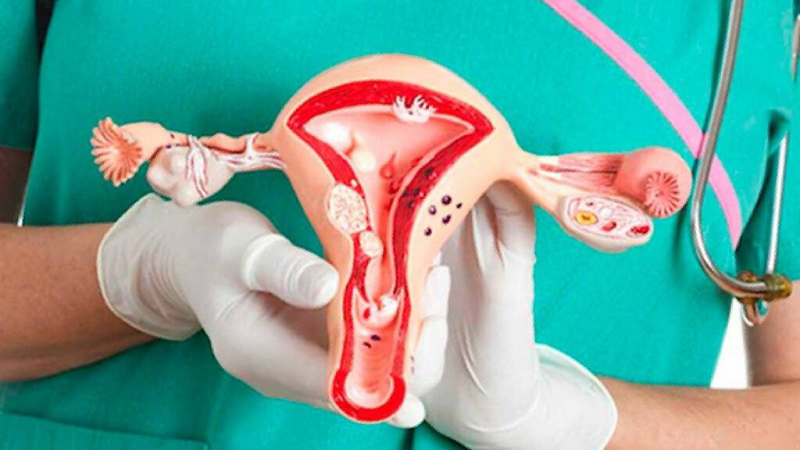 طبيبة تحمل مجسم للرحم