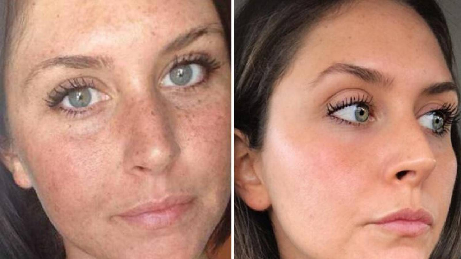 صورة وجه لمرأة تغيرت بشرتها بشكل كبير بعد الولادة و تظهر بقع داكنه 