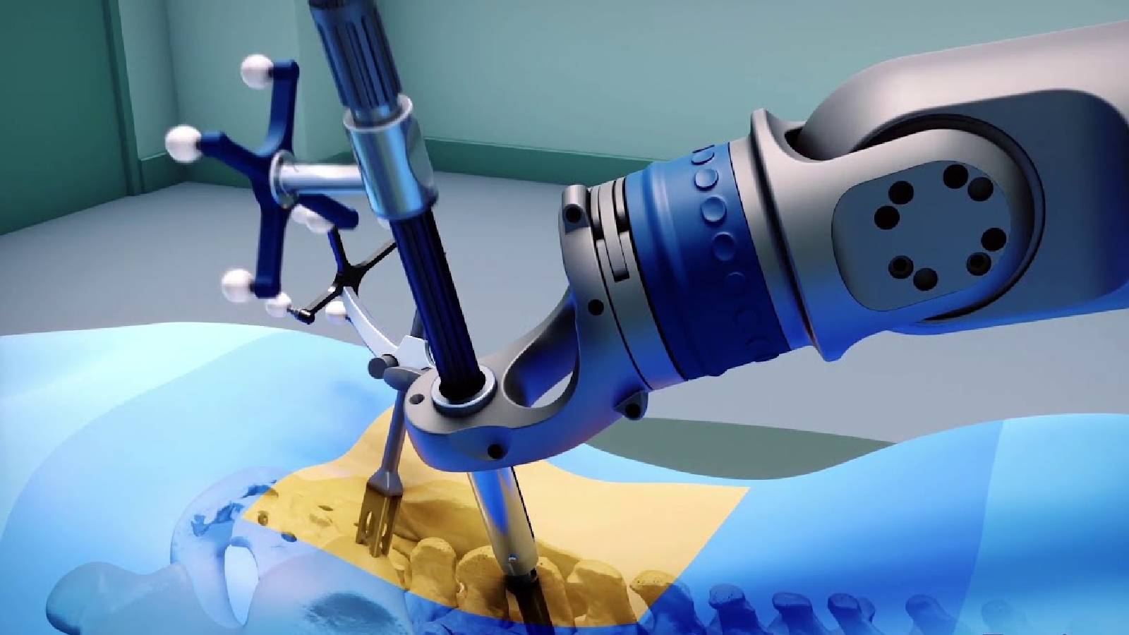 روبوت طبي يقوم بعملية جراحية لمريض في العامود الفقري 