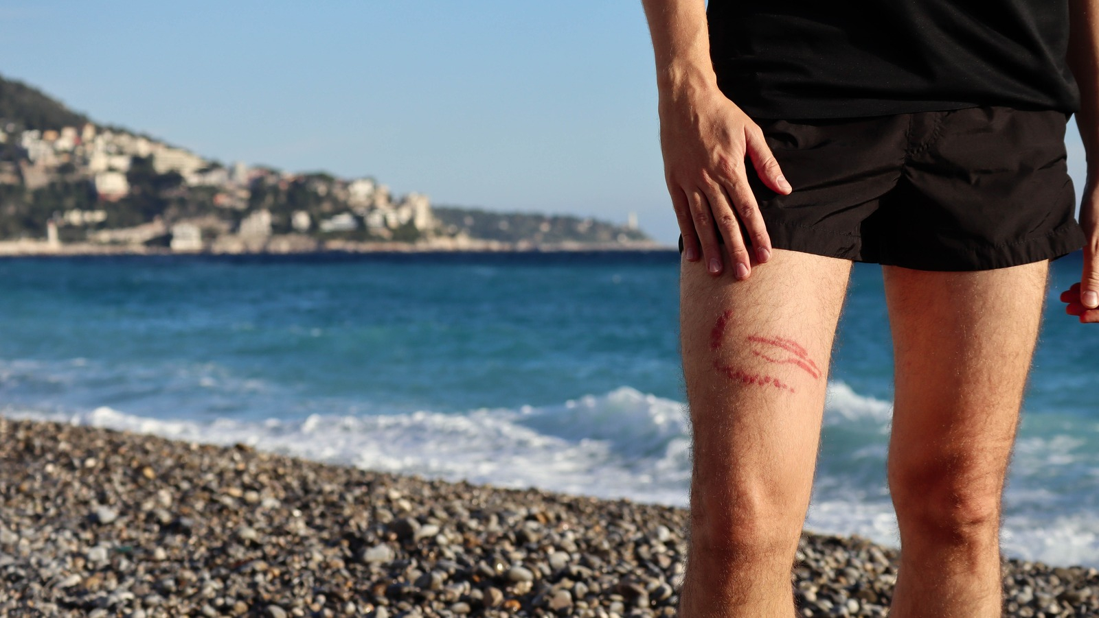 لسعة قنديل البحر