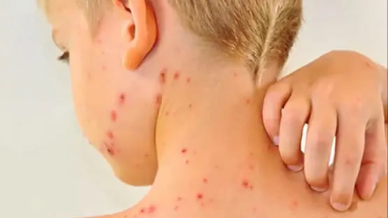 عدم التطعيم