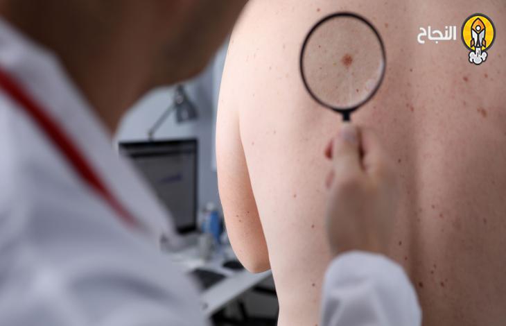 دواء جديد يحد من تفاقم الأورام السرطانية الجلدية