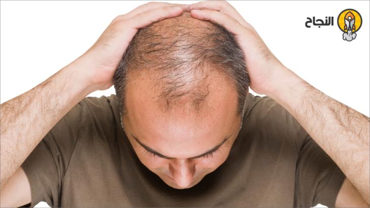 النمط الذكوري للصّلع: كل ما تحتاج لمعرفته