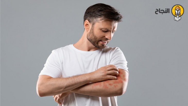 داء بهجت: أسبابه وأعراضه وعلاجه