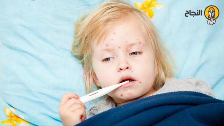 جدري الماء: الأعراض والأسباب والعلاج