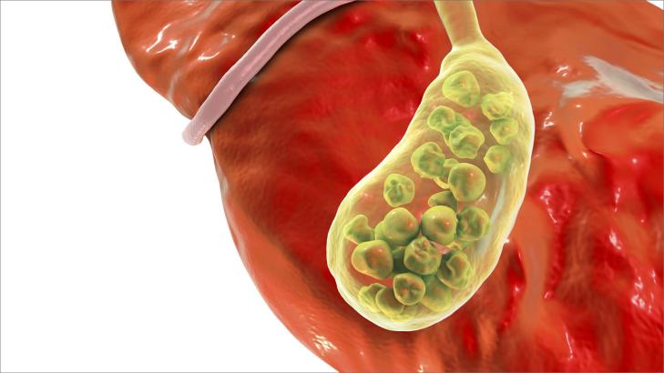 10 علامات تدلُّ على أمراض المرارة وطريقة علاجها