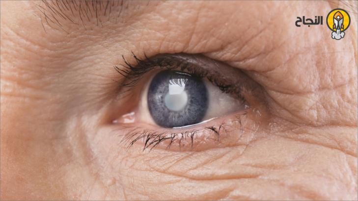الماء الزرقاء في العين: أعراضها ومخاطرها وعلاجها