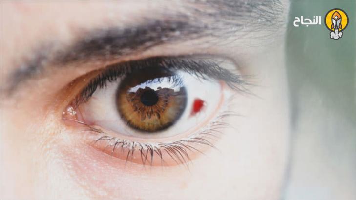 أنواع جلطة العين وأسبابها وطرق العلاج أنواع جلطة العين وأسبابها وطرق العلاج