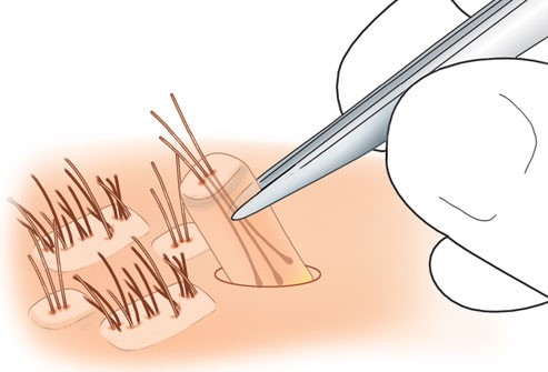 العلاج بزرع الشعر لدى النّساء