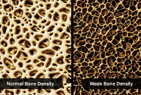 كثافة العظام
