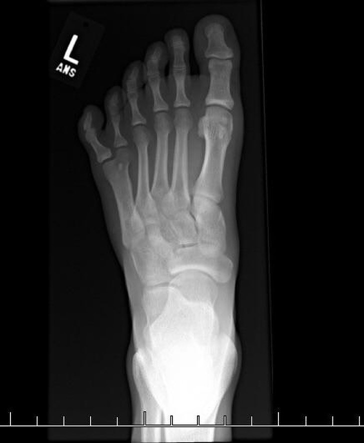 صورة الأشعة السينية التي تُظْهِر قدماً بست أصابع