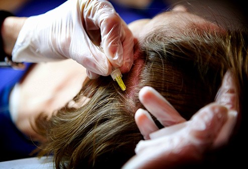 البلازما الغنية بالصفيحات علاج لتساقط الشعر